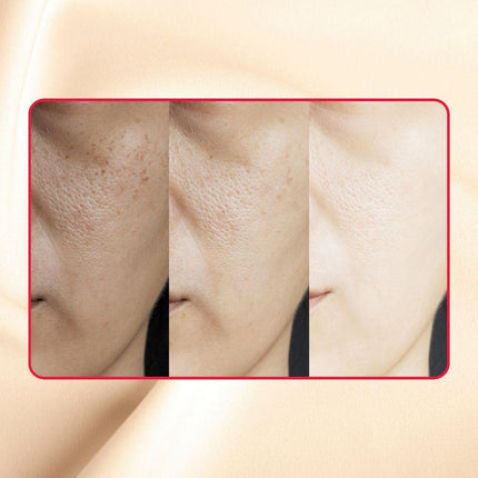 Gymsegbë - Thick As Thieves Pure Glycolic Acid Lactic Acid Extreme Gel Peel - 30ml