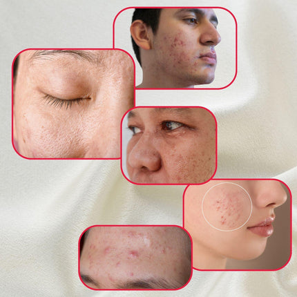Gymsegbë - Perfect Trifecta Acne Peel