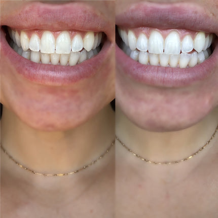 C & D Beauty - Teeth Whitening Strips