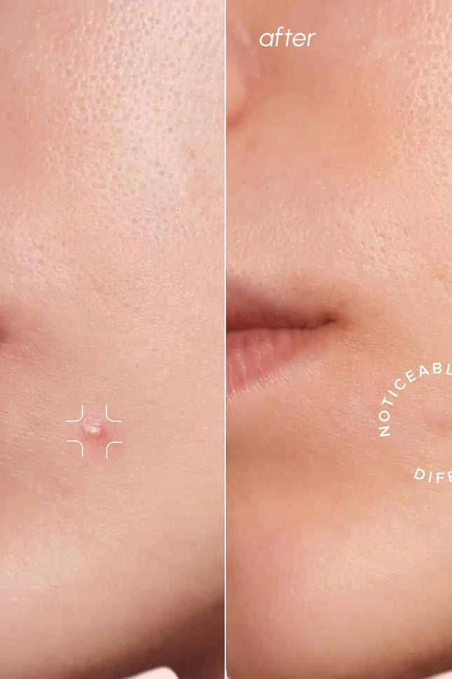 Maree - Invisible Pimple & Acne Patches