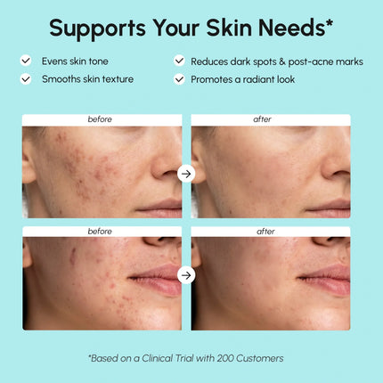 Maree - Azelaic Acid Cream for Sensitive Skin