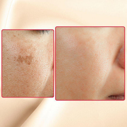 Gymsegbë - The Eraser Spot Cream | Dark Spot Remover