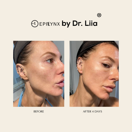 EpiLynx - Pore Refining, Illuminating Serum with Lactic and Salicylic Acid - Gentle