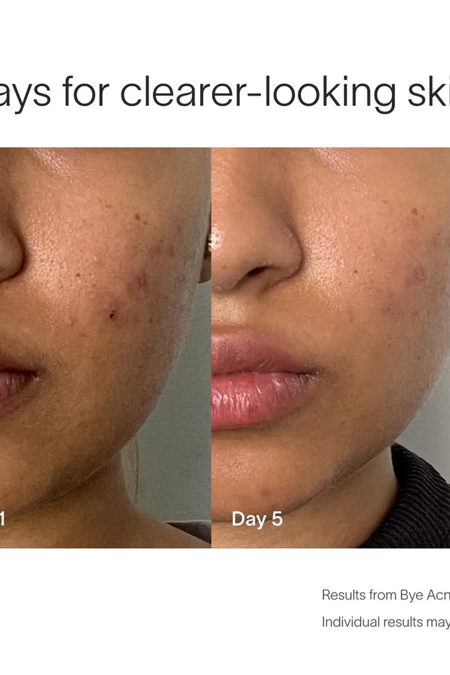 Solawave - Bye Acne Pro Kit